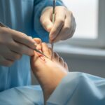 ✅ Hallux valgus: мінімально інвазивна операція | Ортопед